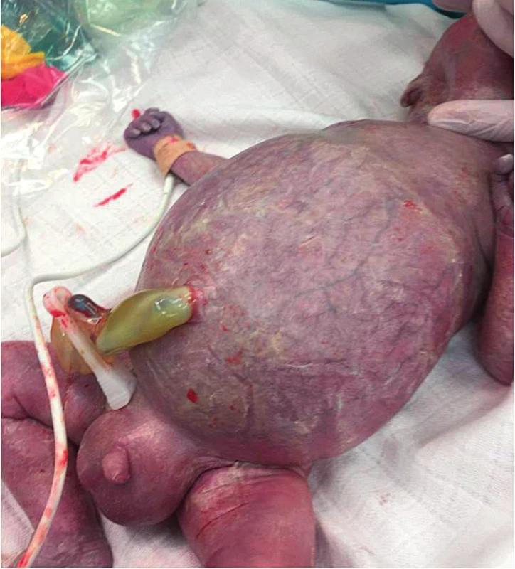 Bezprostřední poporodní nález, výrazný ascites,
hydrotestes, cyanóza