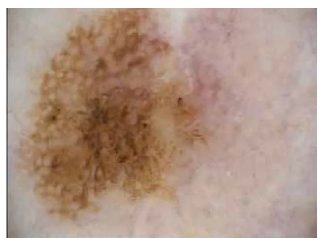 Seboroická veruka*<br>
V části projevu cerebriformní dermatoskopický nález
(gyri et sulci), pseudofolikulární ústí, hnědá pseudosíť.
