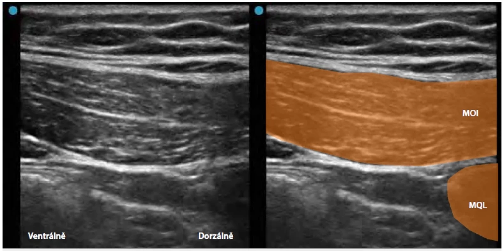 Laterální Quadratus Lumborum Block