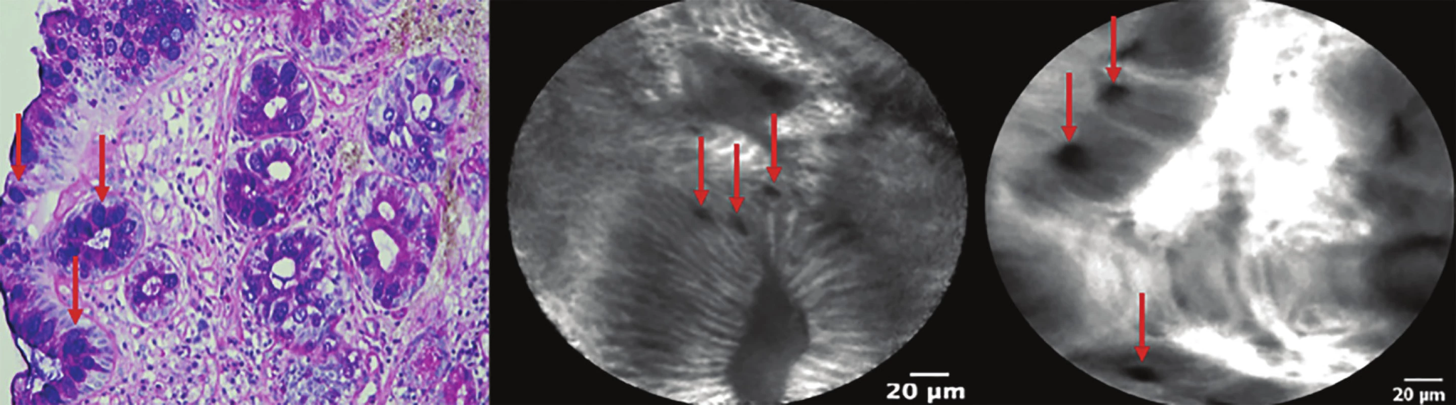 Intestinální metaplazie jícnu (Barrettův jícen)<br>
Šipky označují pohárkové buňky ve žlázkách tvořených cylindrickým epitelem.<br>
Fig. 3: Intestinal metaplasia (Barrett’s esophagus).<br>
Arrows show goblet cells in glands formed by columnar epithelium.