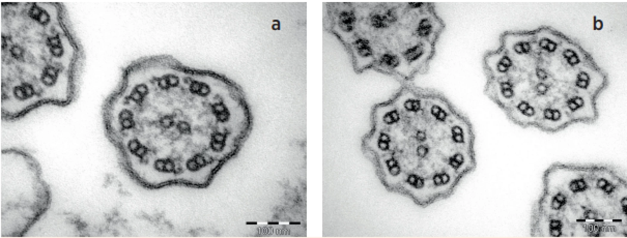 a, b. TEM – a) cilie norma, b) cilie s deficitem vnějších i vnitřních dyneinových ramének (ODA + IDA).<br>
Fig. 3a, b. TEM – a) normal cilia, b) outer and inner dynein arms defect of cilia (ODA + IDA).