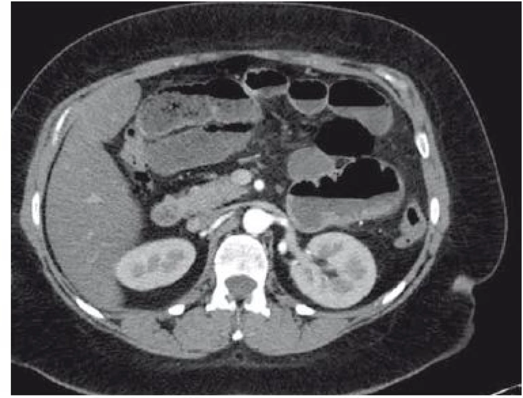 CT obraz dilatované tenké kličky.
Fig 3. CT scan of dilated small intestine.