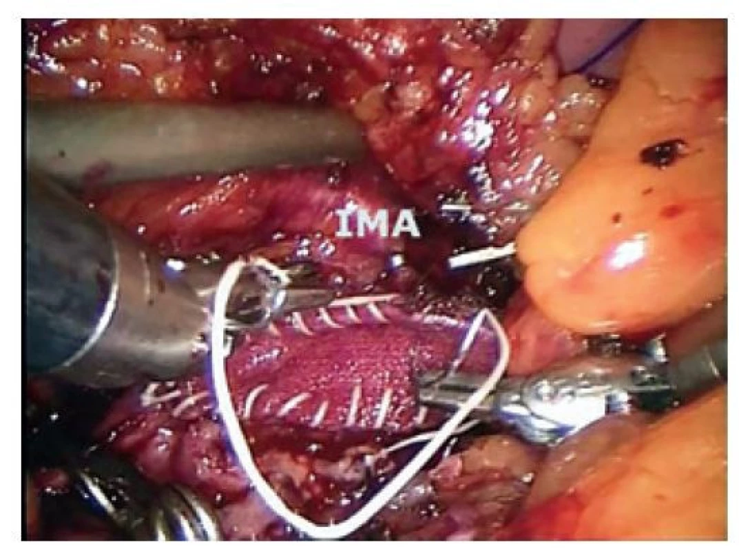 Robotická trombendarterektomie břišní aorty se
záplatou<br>
Fig. 6: Robotic abdominal aortic thromboendarterectomy
with prosthetic patch