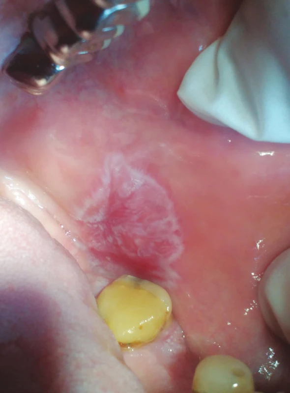 Lichenoidní kontaktní léze
(z archivu autorky)<br>
Fig. 4
Lichenoid contact lesion
(author´s archive)