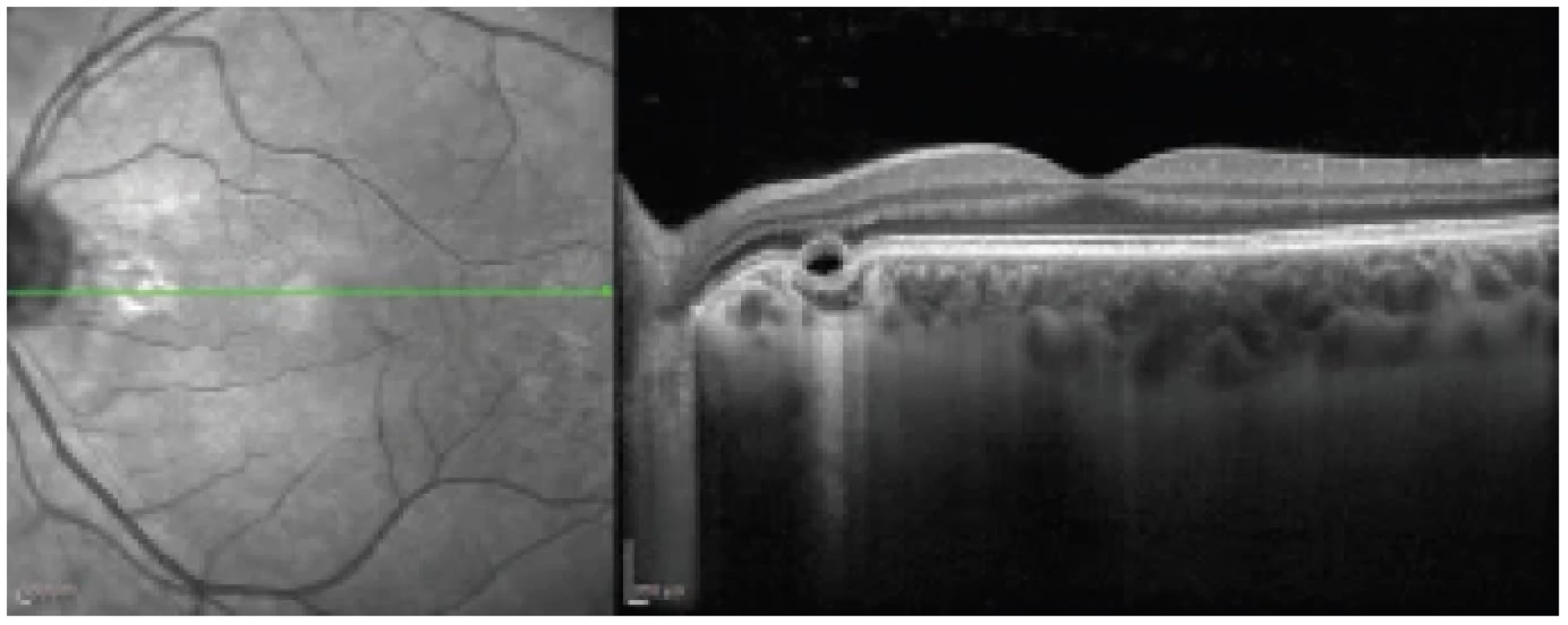 Linear horizontal transfoveolar OCT scan of left eye: focal choroidal excavation of nasal part of macula
