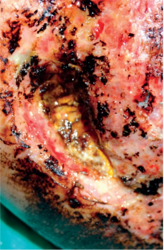 Local sign of invasive fungal infection 