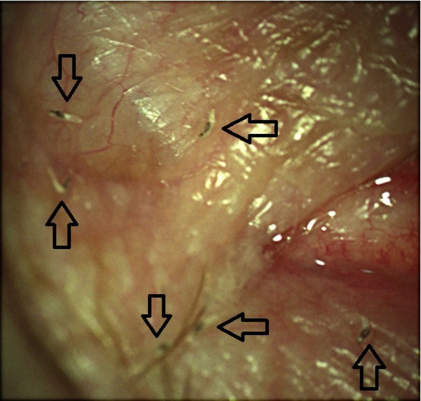 Six individual Oestrus ovis larvae in outer corner of eye