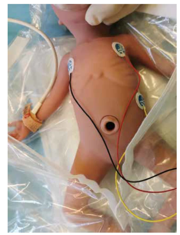 Správné umístění EKG elektrod a senzoru pulzního
oxymetru preduktálně na pravou horní končetinu.<br>
Fig. 3. Proper ECG electrodes placement and pulse oximeter
sensor preductal on the right upper limb.