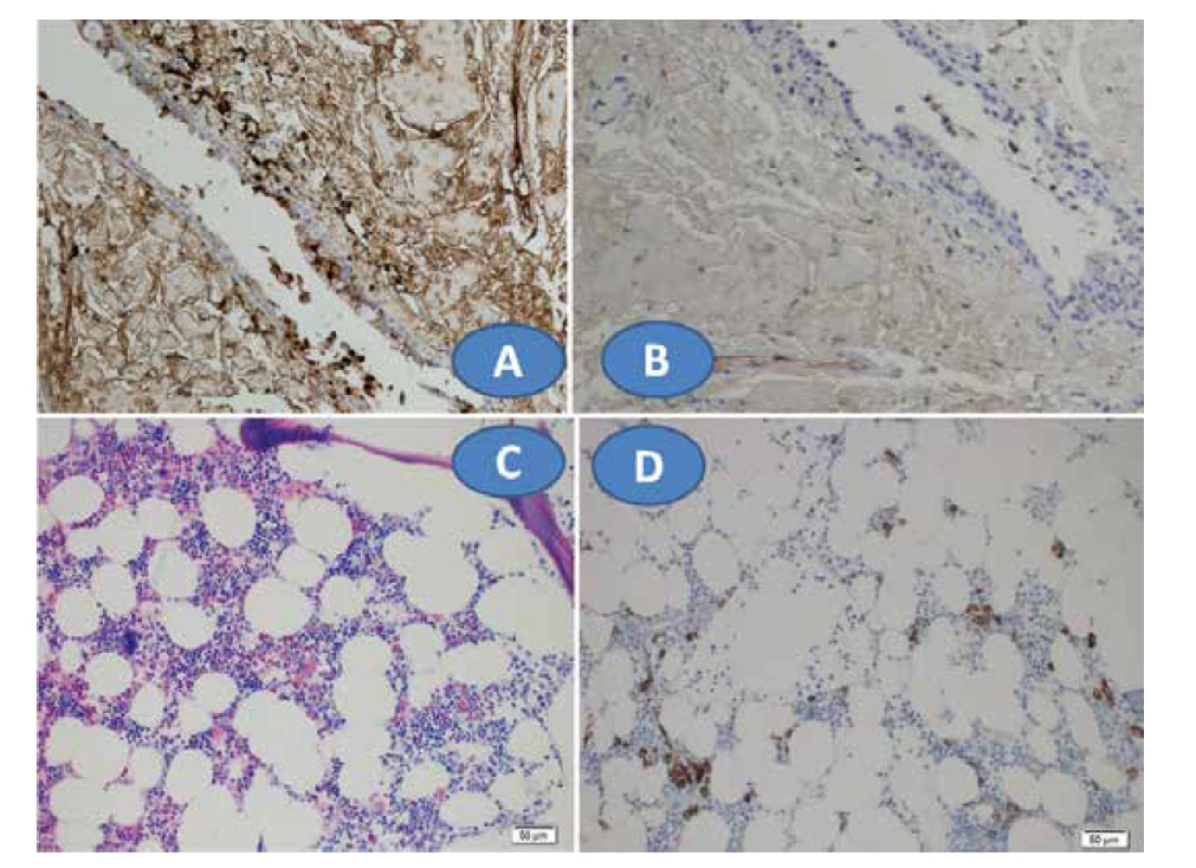 Imunohistochemická vyšetření – pozitivita na lehké řetězce kappa (A) a výrazně slabší pozitivita
na lehké řetězce lambda (B), trepanobiopsie kostní dřeně, Giemsa, zvětšení 200x (C) a imunohistochemie
CD138 (marker plazmocytů), zvětšení 200x (D)