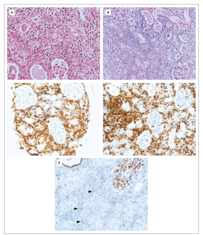 Mikroskopický nález biopsie ledvinného parenchymu v základním barvení hematoxylin-eosinem v celkovém
zvětšení 400x (A), v celkovém zvětšení 200x v barvení Periodic Acid Schiff (B) a imunohistochemický průkaz CD4 (C),
CD43 (D) a CD34 (E).