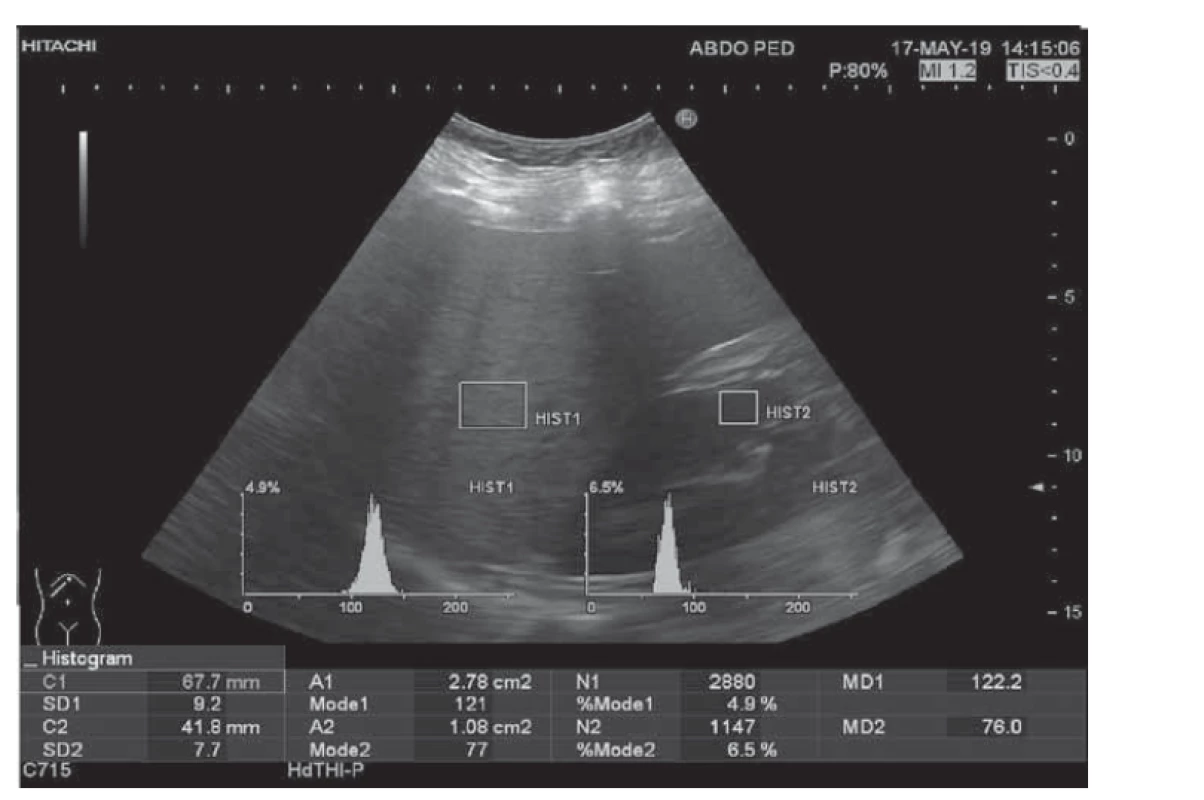 Hodnotenie stupňa steatózy pečene stanovením hepatorenálneho indexu
(HRI 1,61) pomocou ultrasonografie u adolescentnej obéznej pacientky
(BMI 43,07).<br>
Fig. 1. Evaluation of the degree of hepatic steatosis using the hepatorenal index
(HRI 1,61) obtained by ultrasonography in an adolescent obese patient (BMI 43,07).