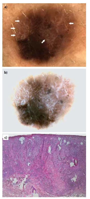 Pacientka, 48 let, nodulární melanom (Breslow 2,19 mm)
z dorzální strany levého předloktí<br>
a) dermatoskopický obraz s přítomností jasných bílých
proužků (šipky)<br>
b) normalizovaný dermatoskopický obraz, který jasné bílé
proužky zvýrazní.<br>
c) histopatologický obraz (HE, 40x).