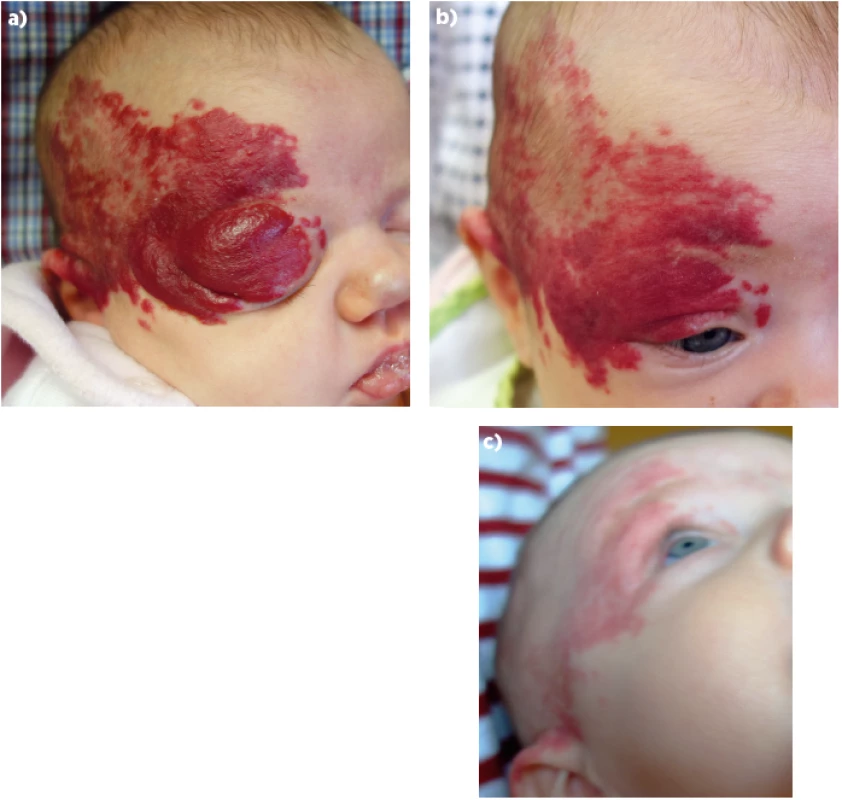 a. Rozsáhlý, včas léčený superficiální IH obličeje (rodiče souhlasí s publikací obrázků jejich dítěte).<br>
Fig. 14a. Extensive superficial face IH treated in time (parents consent with the publication).<br>
Obr. 14b. Rozsáhlý, včas léčený superficiální IH obličeje (rodiče souhlasí s publikací obrázků jejich dítěte).<br>
Fig. 14b. Extensive superficial face IH treated in time (parents consent with the publication).<br>
Obr. 14c. Rozsáhlý, včas léčený superficiální IH obličeje (rodiče souhlasí s publikací obrázků jejich dítěte).<br>
Fig. 14c. Extensive superficial face IH treated in time (parents consent with the publication).