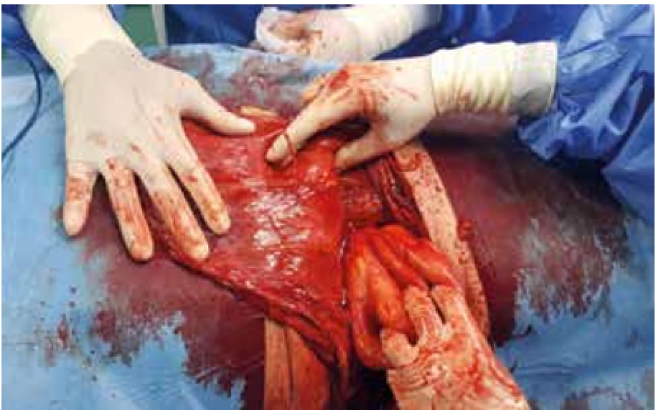 Vypreparovaný vak kýly <br>
Fig. 3. Isolated hernia sac
