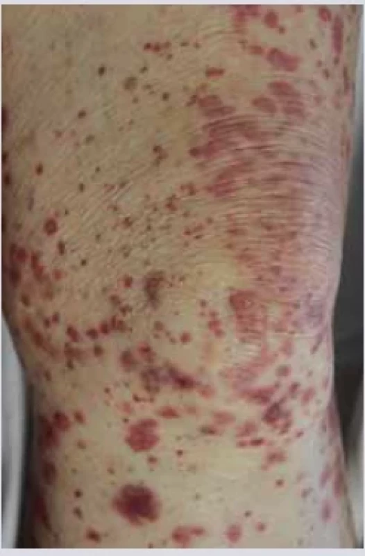 Leukocytoklastická
vaskulitida. <br> 
Fig. 8. Leukocytoclastic vasculitis.