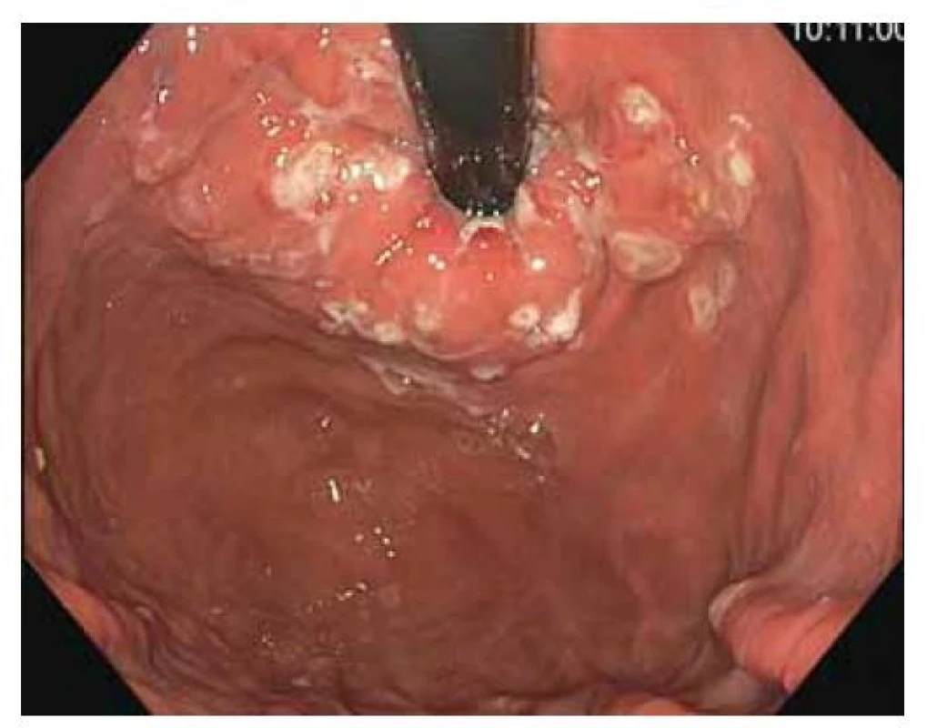 Pohled na EGJ z retroverze po Stretta proceduře.<br>
Zdroj: Archiv Oddělení gastrointestinální endoskopie,
ÚVN – Vojenská fakultní nemocnice, Praha.<br>
Fig. 4. View of the EGJ from the retroversion after
the Stretta procedure.<br>
Source: Department of Gastrointestinal Endoscopy archive,
Military University Hospital, Prague, Czech Republic.