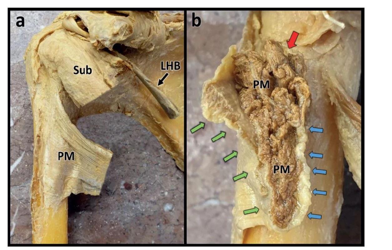 Detail úponu šlachy m. pectoralis major<br>
Fig. 2: Detail of the insertion of pectoralis major tendon