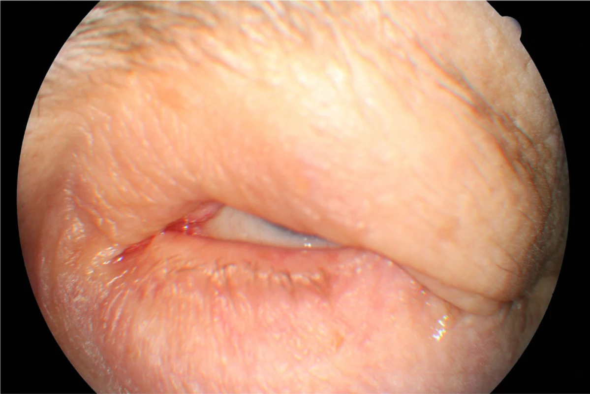 Clinical findings Patient 1 in year 2015 by the maximum
effort to close the eyelids