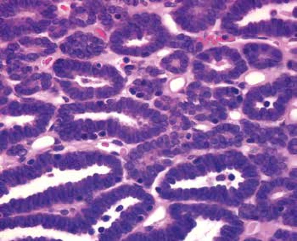 Tightly packed small uniform tumor cells with the hyperchromatic
round to oval partially overlapping nuclei and scant cytoplasm. Nucleoli and
mitotic figures are not apparent (HE, 630x).