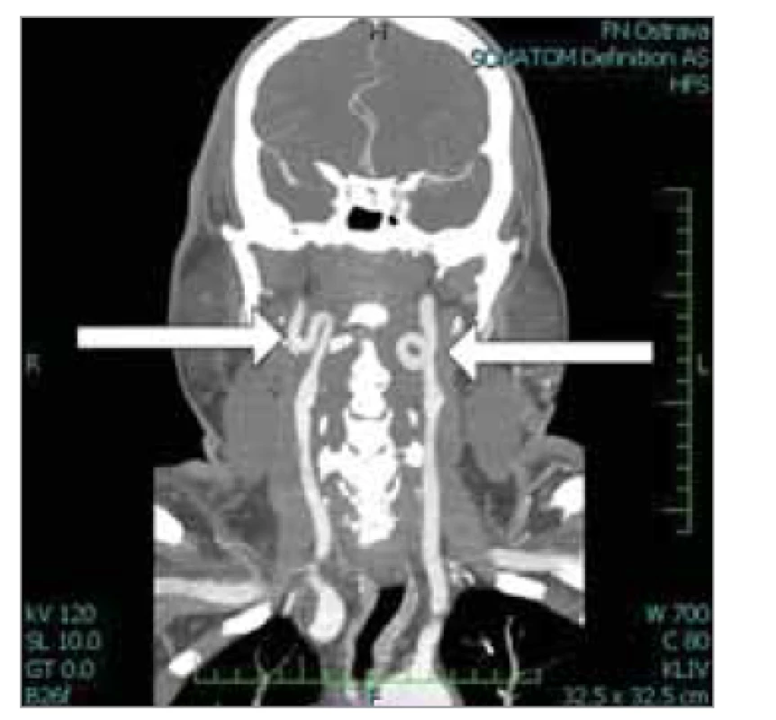 Pravostranný kinking a levostranný
coiling a. carotis interna.<br>
Fig. 6. Right-sided kinking and left-sided
coiling of the internal carotid artery.