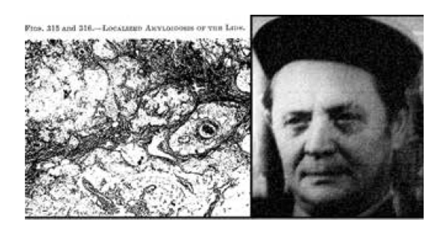 Vlevo – depozita amyloidu ve víčku (převzato
z Duke-Elder, S.: System of Ophtalmology, Kimpton, 1974,
Vol. XIII. p. 313), vpravo – prof. MUDr. František Vrabec, DrSc
(1911–2000)