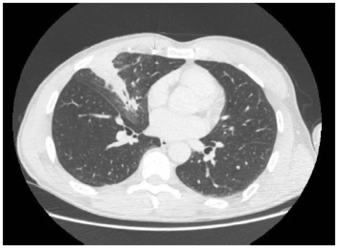 Redukcia zápalových zmien a anomálnych ciev po
predchádzajúcej antibiotickej liečbe a embolizácii (CT
pracovisko NÚTPCHaHCH Vyšné Hágy) <br> 
Fig. 2. Reduction of inflammatory changes and anomalous
vessels after previous antibiotic treatment and embolization
(CT department, NUTPCHaHCH Vysne Hagy,
Vysoke Tatry)