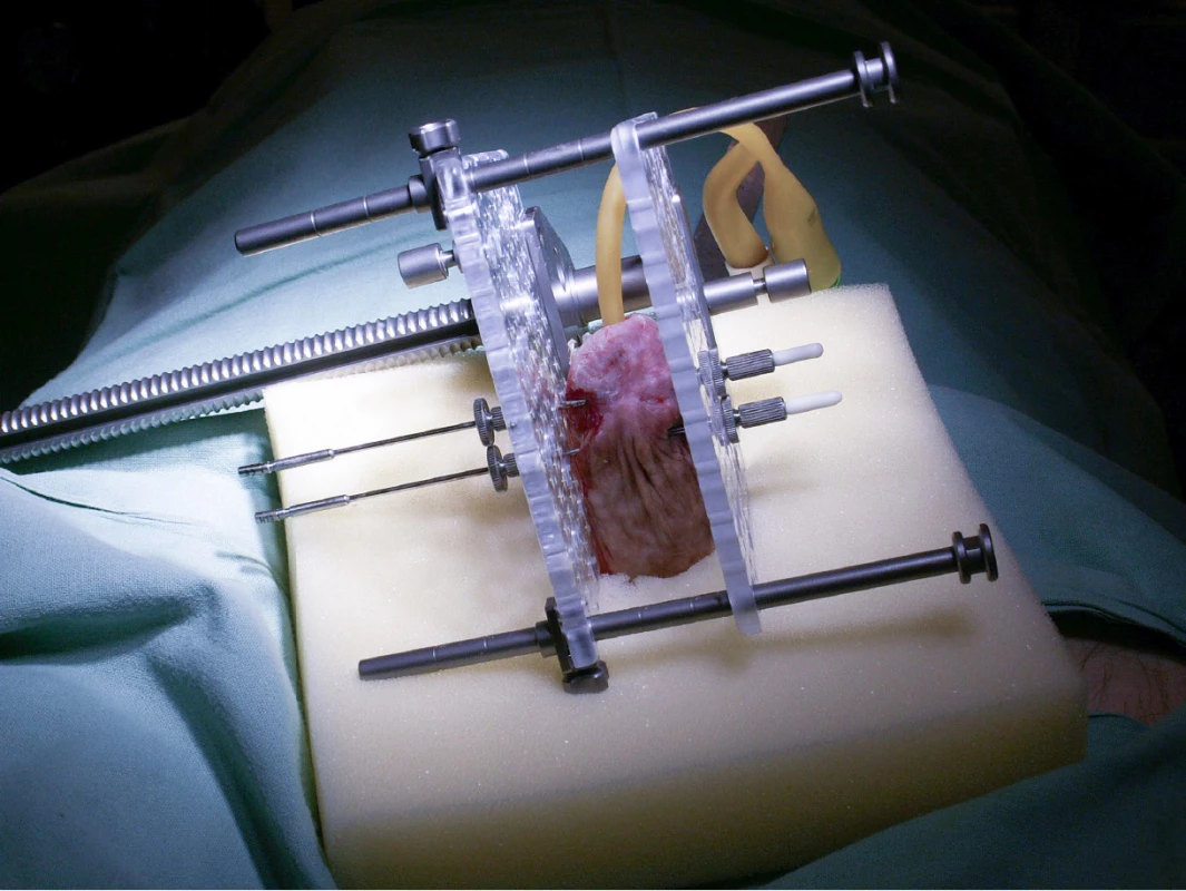 Brachyterapeutický aparát<br>
Fig. 1. Brachytherapy apparatus