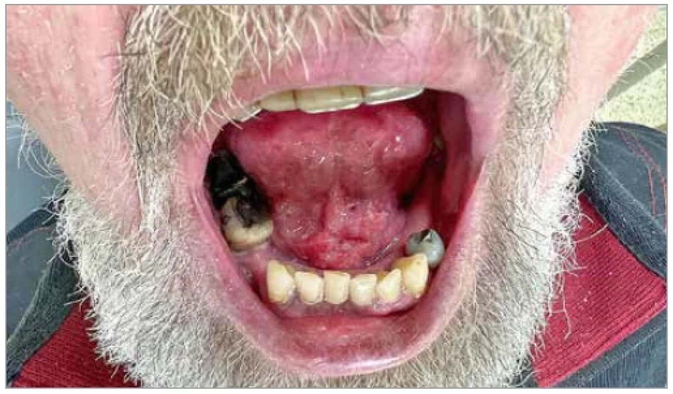 A patient with oral squamous cell carcinoma of the floor of the mouth,
cT2-3.
