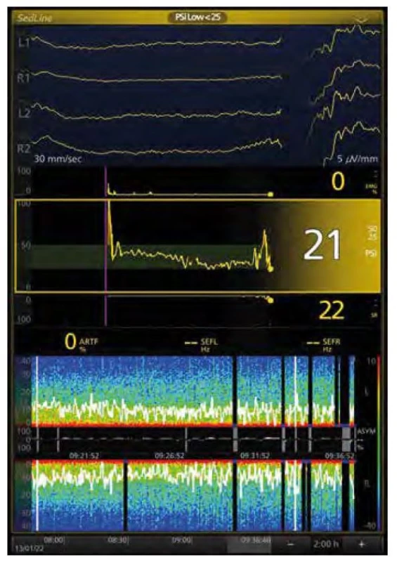 Burst suppression: EEG a spektrogram u 75leté pacientky (propofol,
sufentanil, sevofluran). V horní části syrové EEG křivky, zleva 3 sekundy
isoelektrická linie, v čtvrté sekundě burst, hodnota PSI (Patient State Index)
21, v dolní části Suppression Ratio (SR) 22 (ideálně 0, EEG bez BS), na spektrogramu
za posledních 20 minut v pravé části obraz BS: černé sloupce
s modrou patkou přerušující spektrum