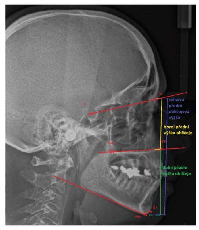 Lateral cephalogram expressing the term „anterior facial height“<br>
N: nasion;<br>
S: the middle of sella turcica;<br>
Spp: the most posterior point on spina nasalis posterior;<br>
Spa: the most anterior point on spina nasalis anterior;<br>
Me: menton, the lowest point on mandibular symphysis;<br>
Gn: gnathion, the lowest point of the midline of the lower jaw