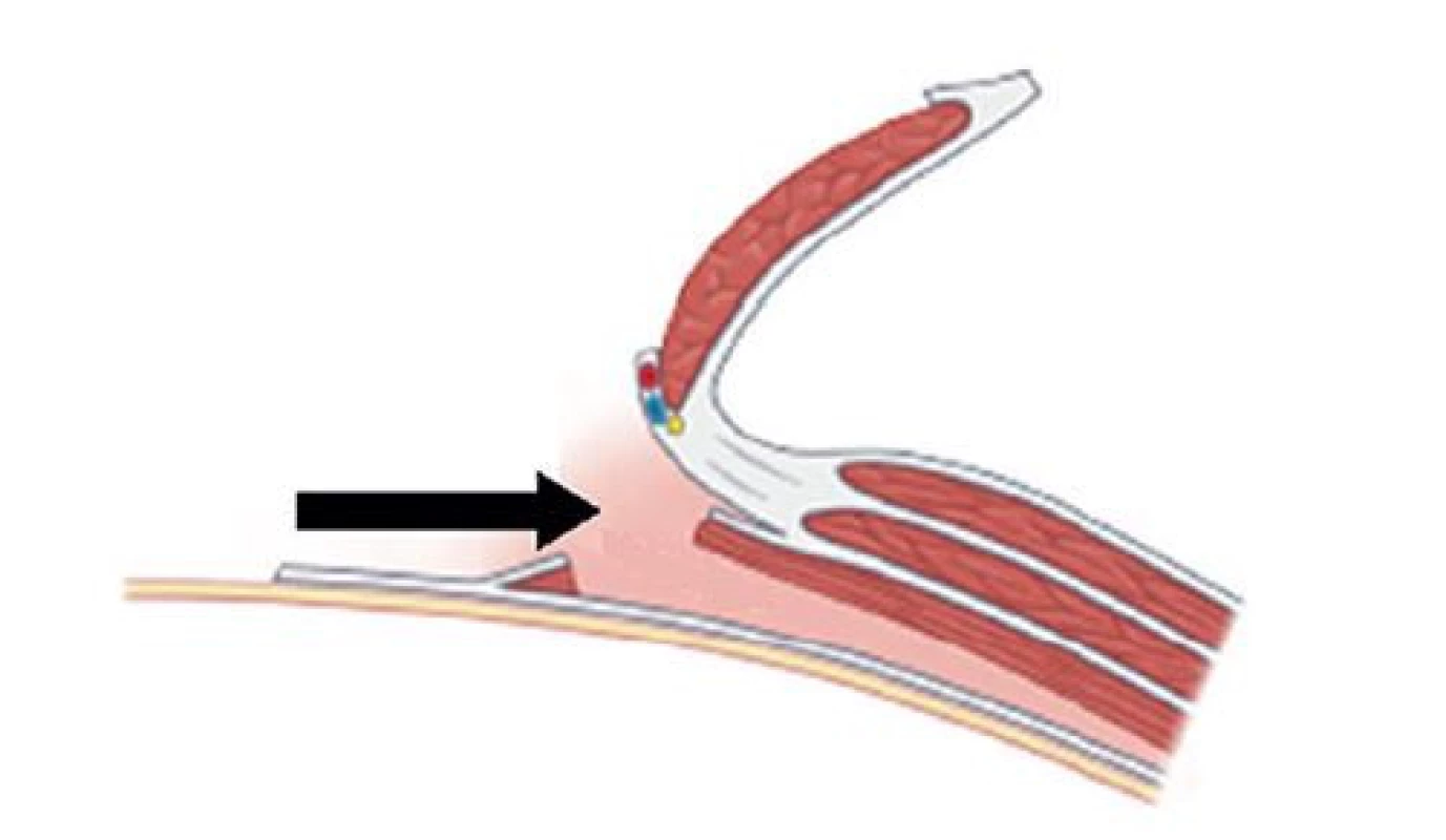 Incize zadního listu pochvy MRA a přerušení úponů
MTA<br>
Fig. 4: Posterior MRA sheath incision and MTA attachment
transection