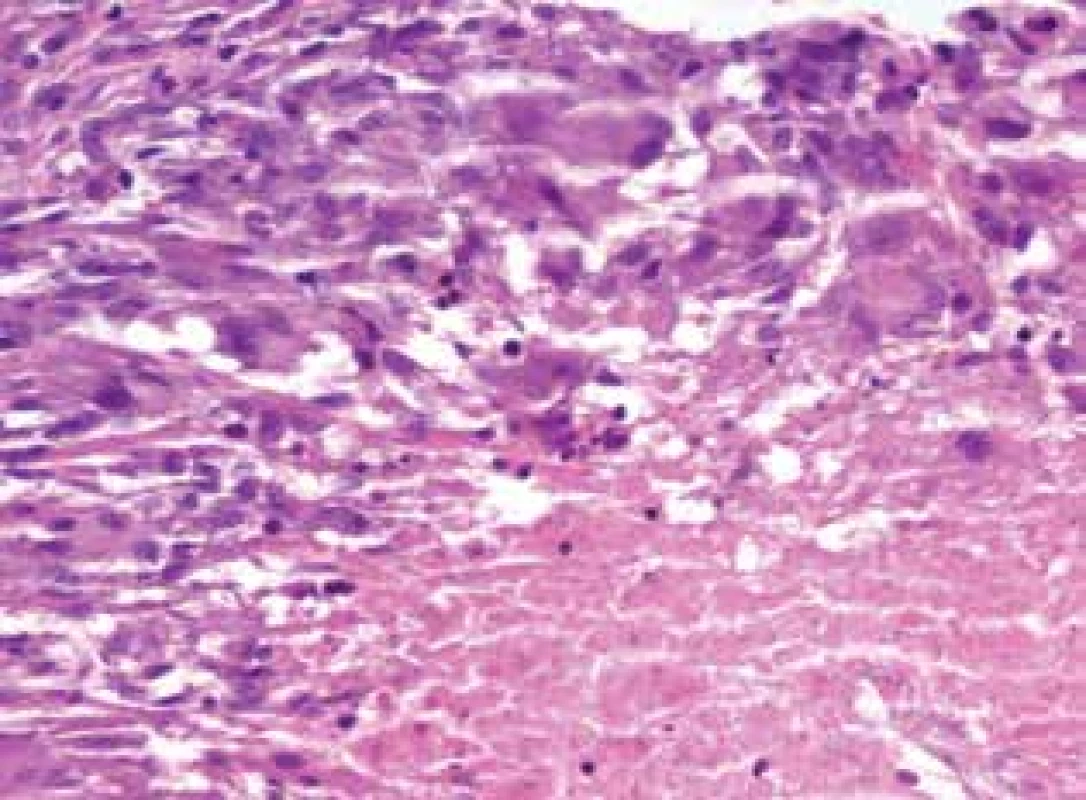 Lupus miliaris disseminatus faciei: okraj kaseifikujícího
granulomu s kaseifikující nekrózou a lemem z histiocytů, i vícejaderných
(HE 400x)