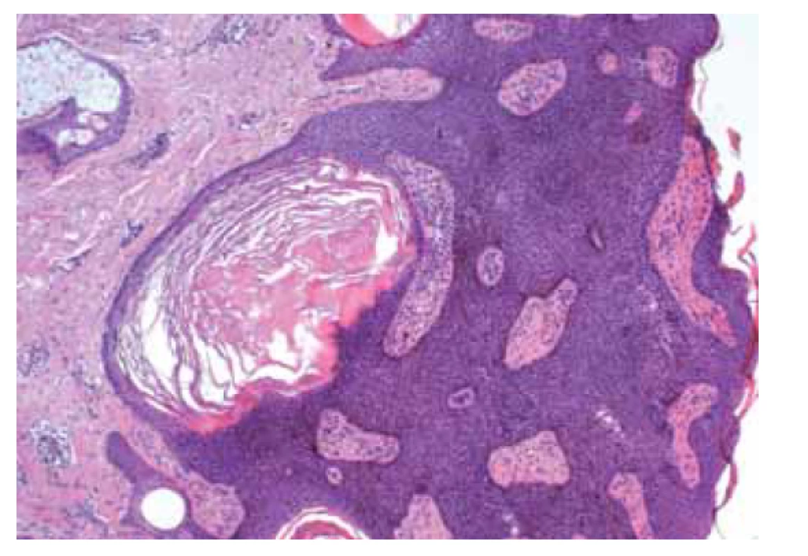 Pigmentovaná seboroická keratóza.<br>
Fig. 4. Pigmented seborrheic keratosis.