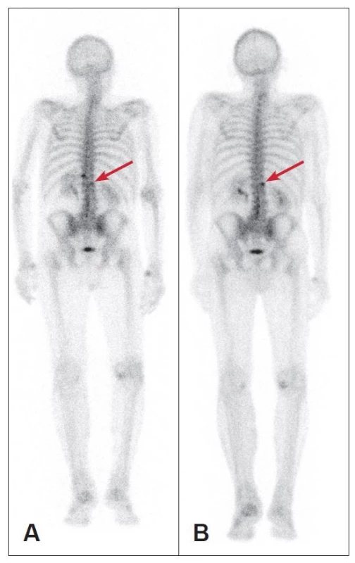V březnu (A) a v prosinci (B) provedený celotělový kostní scan
zobrazuje vícečetná ne příliš výrazná ložiska patologicky zvýšené kostní
přestavby v páteři v oblasti Th 12 vlevo a L1 vpravo (šipka). Na kontrolním
scanu již není patrné ložisko v Th 12, zvýrazňuje se ložisko v L1.
Kromě toho jsou patrné metabolicky aktivní degenerativní změny krční
páteře a kloubů (ramena, zápěstí, pravé koleno).