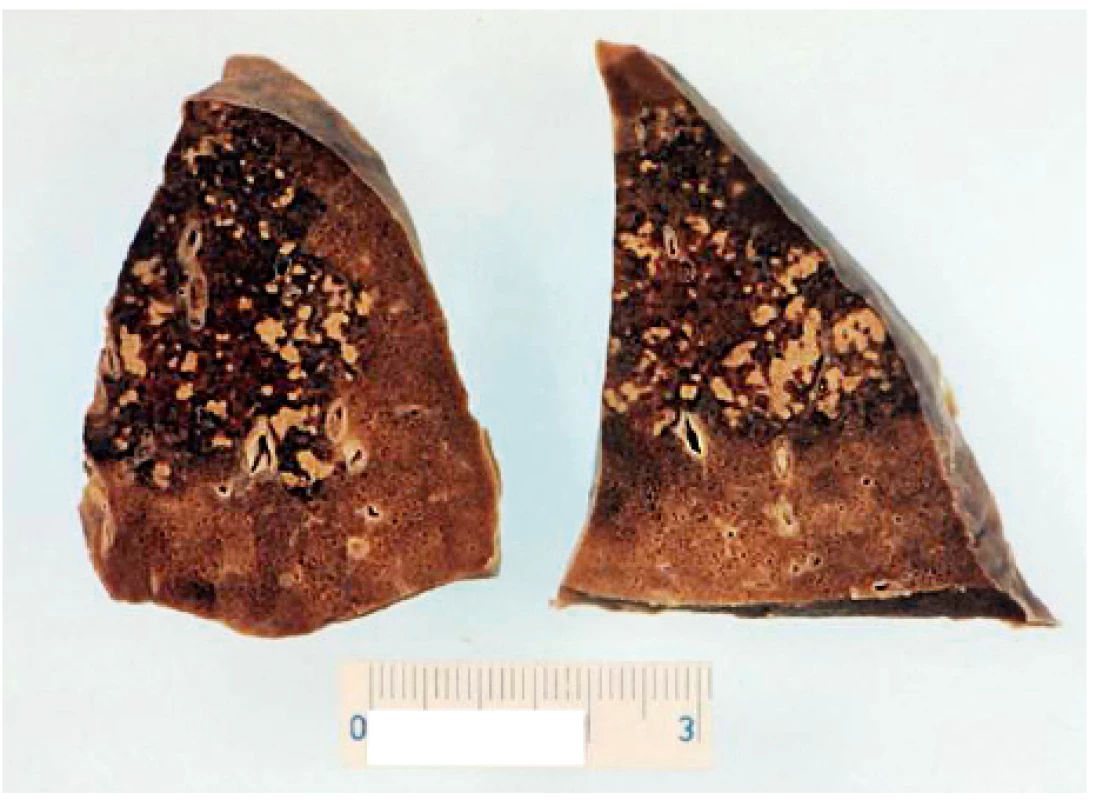 Eozinofilní granulomatóza s polyangiitidou (Churga-
-Straussové) s fatálním průběhem u 24leté ženy – pitevní nález: dvě
lamely plic s vícečetnými uzly (33)