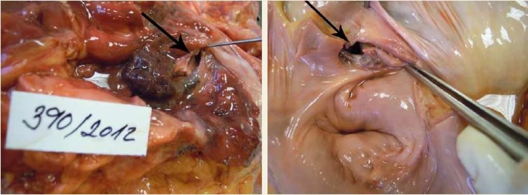 Atrio-ezofageální píštěl.<br> Fig. 2. Atrio-oesophageal fistula.