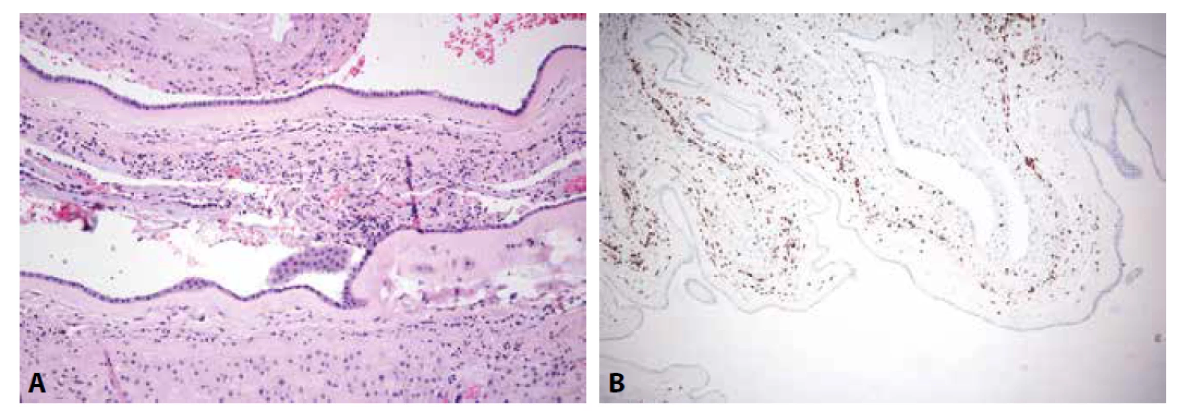 A: Chronická chorioamnionitida plodových obalů (HE, 200x). B: Chronická chorioamnionitida. CD8 pozitivní lymfocyty v chorioamniální
pojivé tkáni (CD8, 100x).