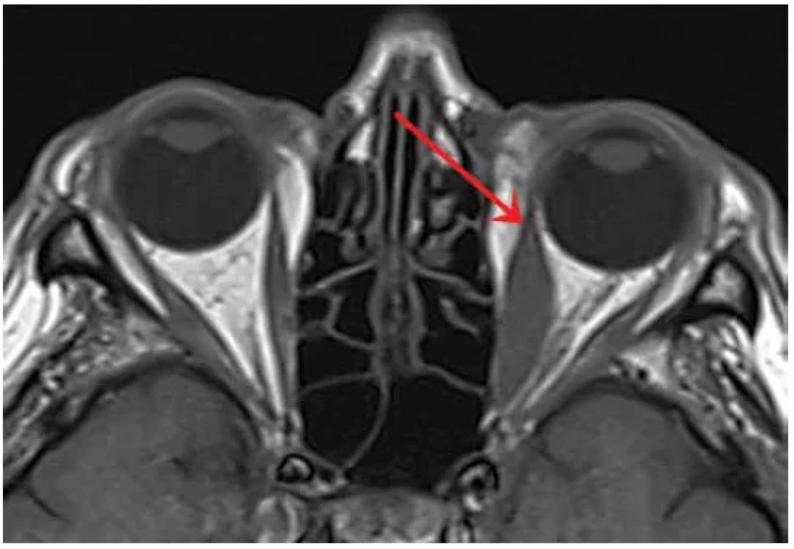 Magnetic resonance – axial image at the level of orbits of a patient with thyroid-associated
orbitopathy, nonenhanced T1-weighted image: left medial rectus muscle is enlarged,
with tendinous insertion spared (arrow)