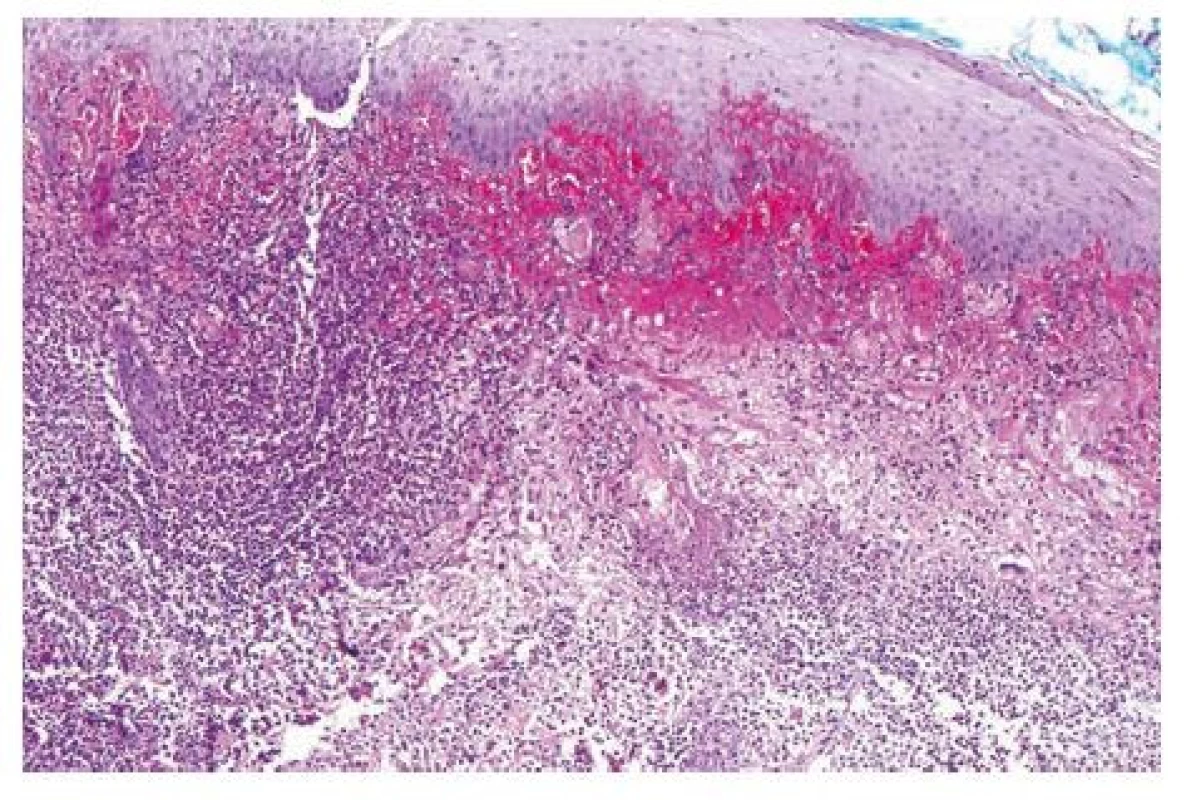 Kožní biopsie, kde pod mírnĕ akantoticky rozšířeným povrchovým epitelem nacházíme difuznĕ splývající smíšený zánĕtlivý infiltrát s převahou neutrofilních a eozinfolních granulocytů. Místy je patrné, že zánĕtlivý infiltrát se nachází i perifolikulárnĕ (hematoxylin-eosin, zvĕtšení 200x) (s laskavostí prof. Kacerovské z FN Plzeň)