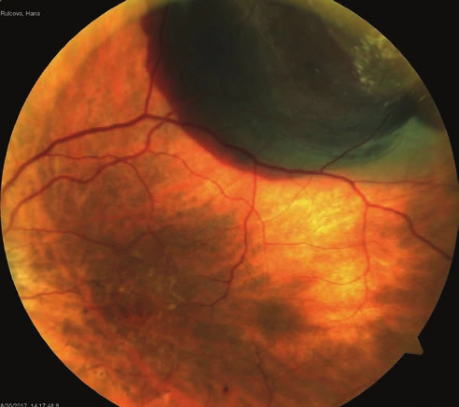 a. Fresh lesion of sub-RPE haemorrhage in LE