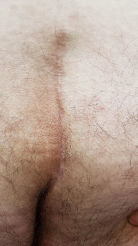 Úplně lateralizovaná rána<br>
Fig. 6: Completely lateralized wound