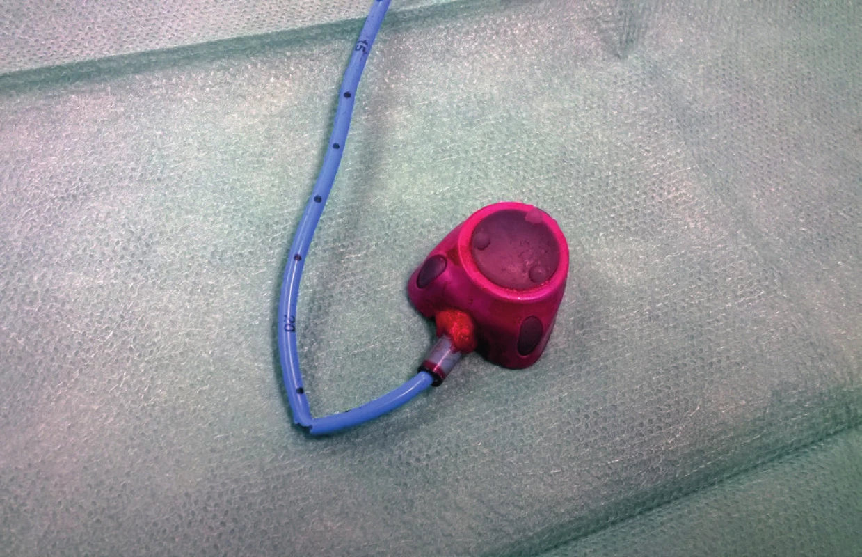 Parciální ruptura katetru portu<br>
Fig. 3. Partial rupture of the port catheter