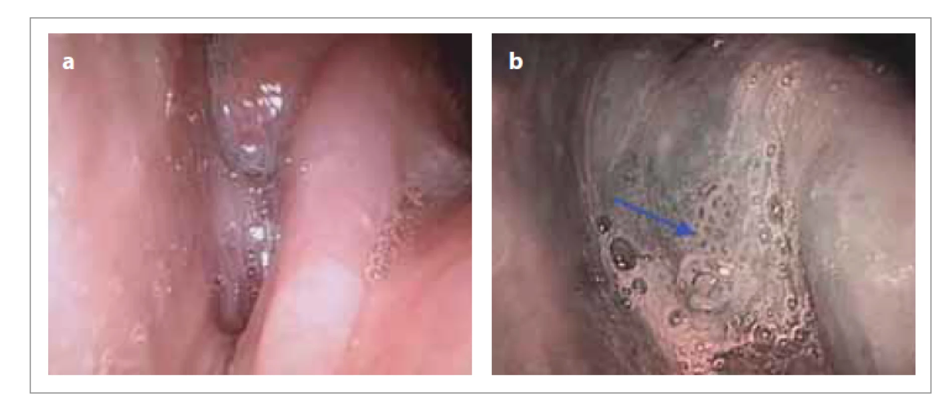 Stav po radiochemoterapii karcinomu hypofaryngu vpravo cT3N2bM0:
a) ambulantní flexibilní endoskopie v konvenčním bílém světle, b) patologická
vaskularizace IPCL typu Vb v pravém piriformním sinu (šipka), ambulantní flexibilní
endoskopie s NBI, histologicky invazivní nerohovějící dlaždicobuněčný
karcinom.<br>
Fig. 5 Condition after radiochemotherapy of right hypopharyngeal carcinoma
cT3N2bM0: a) outpatient flexible endoscopy in conventional white light,
b) pathological vascularization of IPCL type Vb in the right piriform sinus (arrow),
outpatient flexible endoscopy with NBI, histologically invasive non-keratinizing
squamous cell carcinoma.