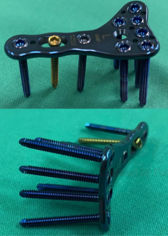 Volární LCP dlaha distální radius 2,5 mm<br>
Fig. 1: LCP volar distal radius plate 2.5 mm