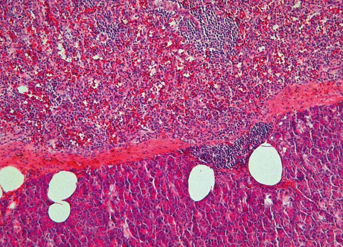 Histologický nález – intrapankreatická akcesorní slezina (IPAS) oddělená
od pankreatické tkáně vazivovým pouzdrem (barvení hematoxylin-eozinem,
zvětšení 100×).
Fig. 2. Histopathological image – intrapancreatic accessory spleen (IPAS) separated
by a fibrous capsule from the pancreatic tissue (Haematoxylin and eosin staining,
magnifi cation 100×).