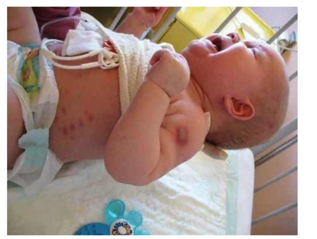 Prejavy BCG-itídy u pacienta so SCID s nepotvrdenou mutáciou (pacient č. 4).<br>
Fig. 2. Manifestations of BCG in SCID patient with an unconfirmed mutation (patient 4).