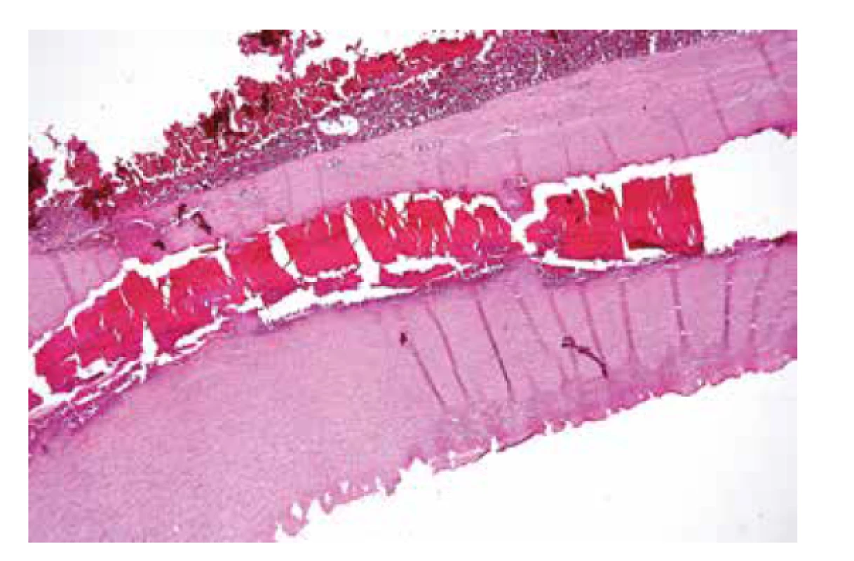 Intramurální hematom destruující tunica media aorty (HE, 4x). <br>
Fig.3. Intramural hematoma destroying tunica media of the aorta (HE, 4x).