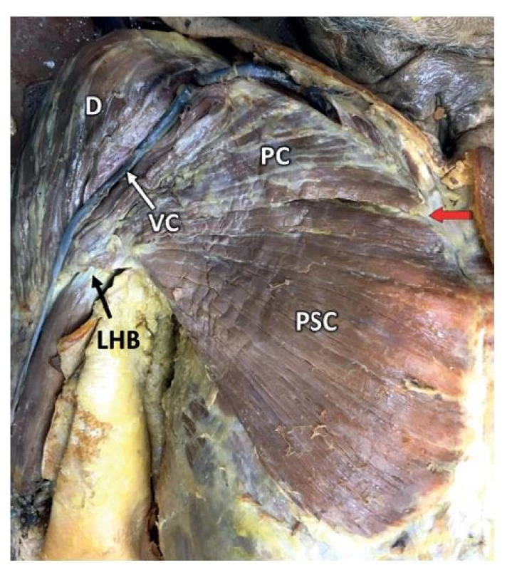 Anatomie m. pectoralis major<br>
Fig. 1: Anatomy of the pectoralis major