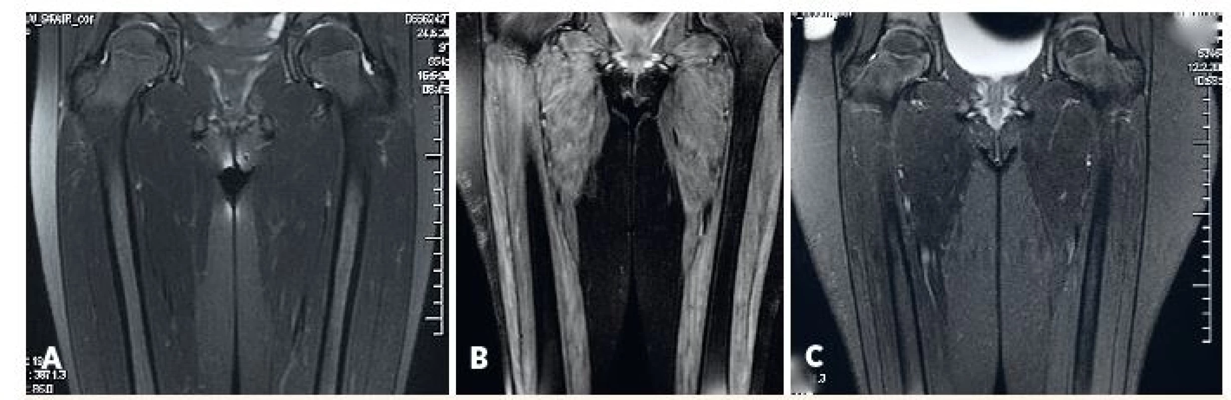 MRI svalov dolného pletenca a stehna.<br>
A) fyziologický nález u pacientky s amyopatickou formou JDM, B) patologický nález u pacientky s floridnou JDM, C) regresia patologických zmien u rovnakej pacientky po liečbe.<br>
Fig. 3. MRI of lower girdle and thigh muscles.<br>
A) physiological findings in amyopathic JDM, B) pahtological findings in active JDM (edema of muscle and subcutis),
C) reversal of pathological findings in the same patient after treatment.