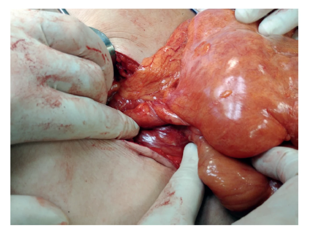 Malrotace – operační nález mesenterium commune<br>
Fig. 2: Malrotation – surgical findings of the common mesentery